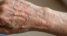 managing dry skin effectively